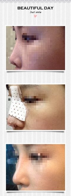 시술 후기